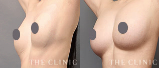 セルチャー豊胸モニターの症例画像｜THE CLINIC