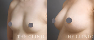 ボリュームアップのコンデンスリッチ豊胸モニターの症例画像｜THE CLINIC