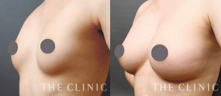 ボリュームアップのコンデンスリッチ豊胸 Dr.セミナーモニターの症例画像｜THE CLINIC