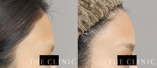 おでこのコンデンスリッチファット注入モニターの症例画像｜THE CLINIC