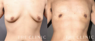女性化乳房治療モニターの症例画像｜THE CLINIC