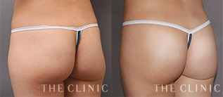 下がったお尻のハートヒップリフトモニターの症例画像｜THE CLINIC