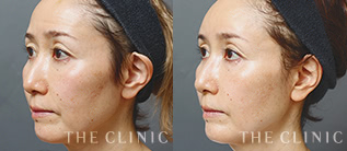 頬の痩けのSRF注入 Dr.セミナーモニターの症例画像｜THE CLINIC
