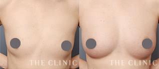 上向きバスト豊胸モニターの症例画像｜THE CLINIC