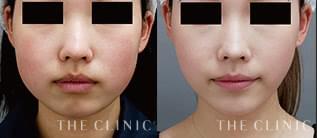 ベイザーリポ2.0（ベイザー脂肪吸引）モニターの症例画像｜THE CLINIC
