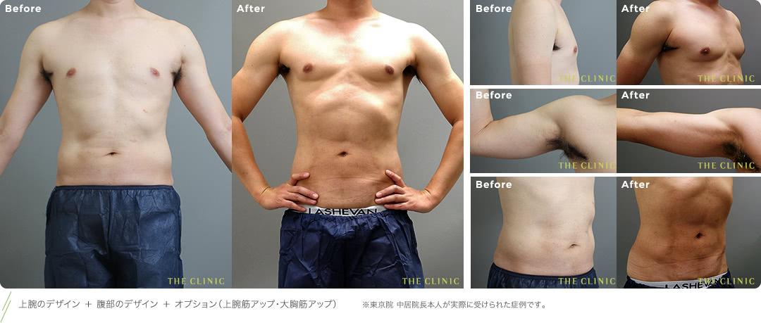 上腕のデザイン ＋ 腹部のデザイン ＋ オプション（上腕筋アップ・大胸筋アップ） ※東京院 中居院長本人が実際に受けられた症例です。 