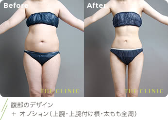 腹部のデザイン ＋ オプション（上腕・上腕付け根・太もも全周）