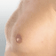 女性化乳房治療(男性の胸の膨らみ改善)