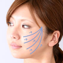 シルエットリフトの施術