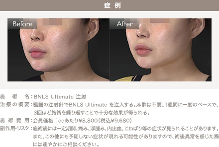 BNLS Ultimate 注射の施術2