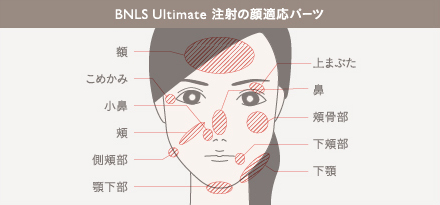 BNLS Ultimate 注射の施術6