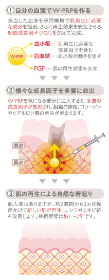 W-PRP プレミアム(血小板療法)の施術2