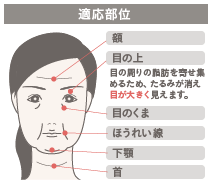 イレブンリフト(糸のフェイスリフト)の施術3