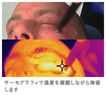 サーミ スムースの施術2