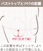 アンダーブーブ豊胸(下乳形成)の施術2