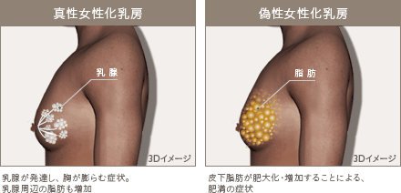 女性化乳房