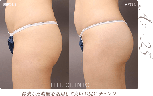 30歳 HIP MAKE by 360脂肪吸引®の症例 垂れたお尻が引き締まり老け見え解消