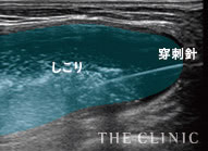 溶解液注入