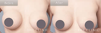 シリコンバッグ豊胸の違和感の症例画像