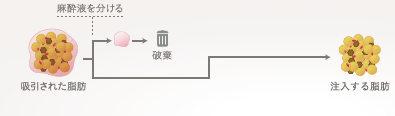 従来の脂肪注入