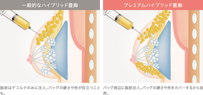 一般的なハイブリッド豊胸とプレミアムハイブリッド豊胸の違い