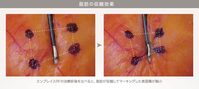 脂肪の収縮効果：エンブレイスRFの治療前後を比べると、脂肪が収縮してマーキングした表面積が縮小