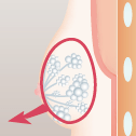 乳腺切除＋脂肪吸引＋レヌビオン の手順 乳腺摘出