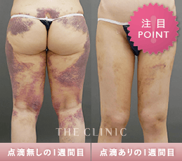 脂肪吸引術後の専用コスメ「ダウンタイム」のクリームとローション