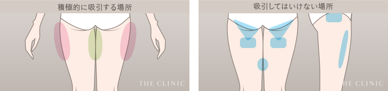 外の張り出しと内腿はしっかり／お尻の下は絶対に吸引しない