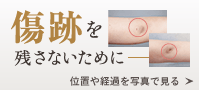 傷跡を残さないために 位置や経過を写真で見る