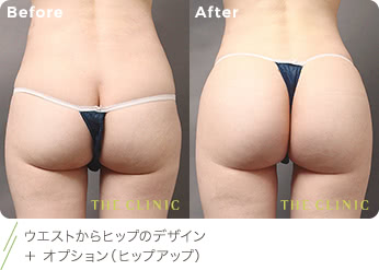 ウエストからヒップのデザイン ＋ オプション（ヒップアップ）