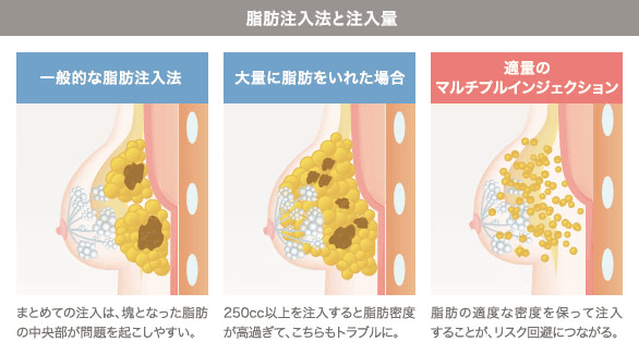 脂肪の注入方法が豊胸効果に与える影響