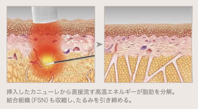 挿入したカニューレから直接流す高温エネルギーが脂肪を分解。結合組織（FSN）も収縮し、たるみを引き締める。