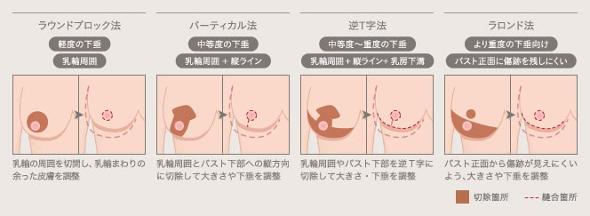 乳房吊り上げ術・縮小術の４つの術式（ラウンドブロック法、バーティカル法、逆T字法、ラロンド法）