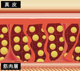 皮膚の凸凹（セルライト）ができるまでのメカニズム１