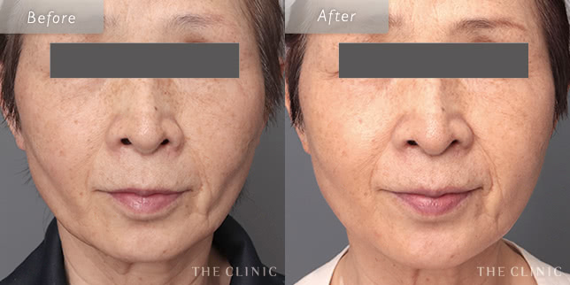 頬のコケの68歳女性の症例写真