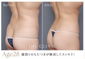 28歳女性がくびれ脂肪吸引で腰周りのもたつきを解消した症例