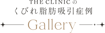 THE CLINIC のくびれ脂肪吸引症例