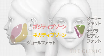 顔の脂肪吸引の取るべきゾーンと取ると失敗するゾーンの説明