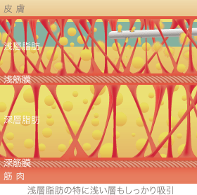 スーパーフィッシャルリポサクション技術