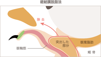 経結膜脱脂法の施術イメージ