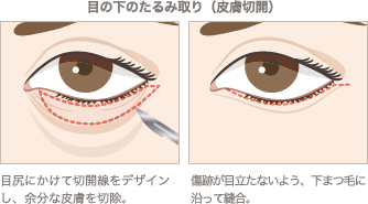 目の下のたるみ取り（皮膚切開）の施術イメージ