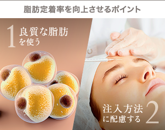 脂肪定着率を向上させるポイント：1.良質な脂肪を使う、2.注入方法に配慮する