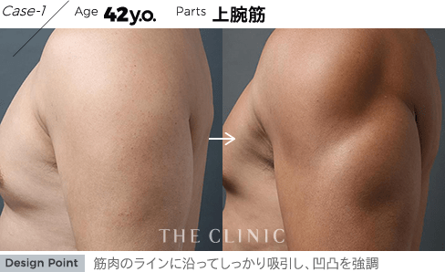 Case-1 Age 42y.o. Parts 上腕筋 | 筋肉のラインに沿ってしっかり吸引し、凹凸を強調