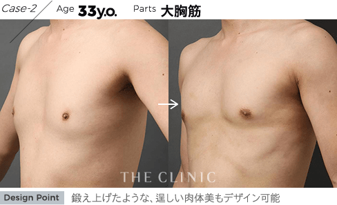 Case-2 Age 33y.o. Parts 大胸筋 | 鍛え上げたような、逞しい肉体美もデザイン可能