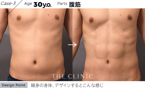 Case-3 Age 30y.o. Parts 腹筋 | 細身の身体、デザインするとこんな感じ