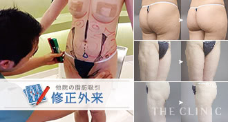 脂肪吸引の他院失敗修正の様子と症例