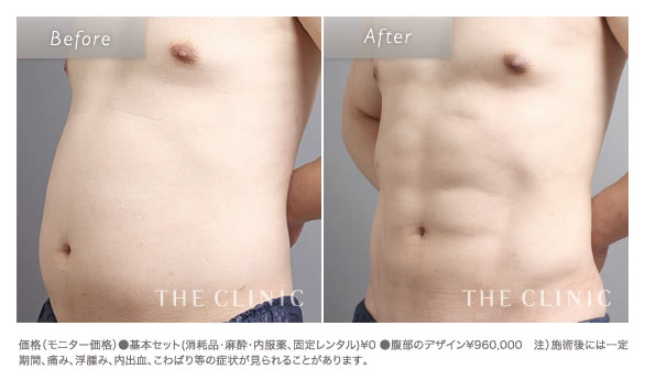 男性の脂肪吸引症例（腹部）