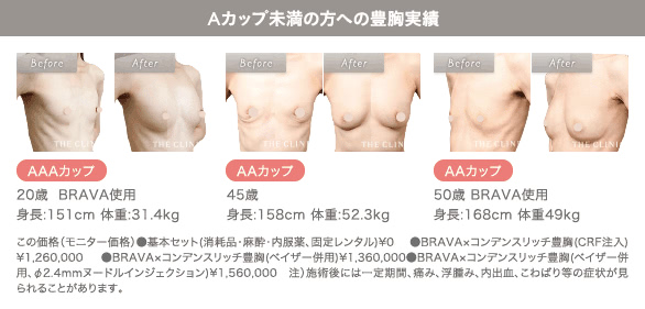 痩せ型ゲストのコンデンスリッチ豊胸