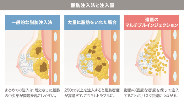 脂肪の注入方法が豊胸効果に与える影響